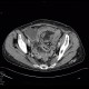 Pyometra, reactive changes of small bowel: CT - Computed tomography